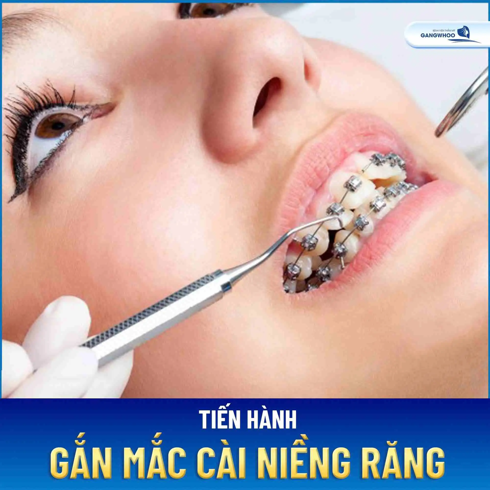 Lấy dấu hàm và thiết kế mắc cài