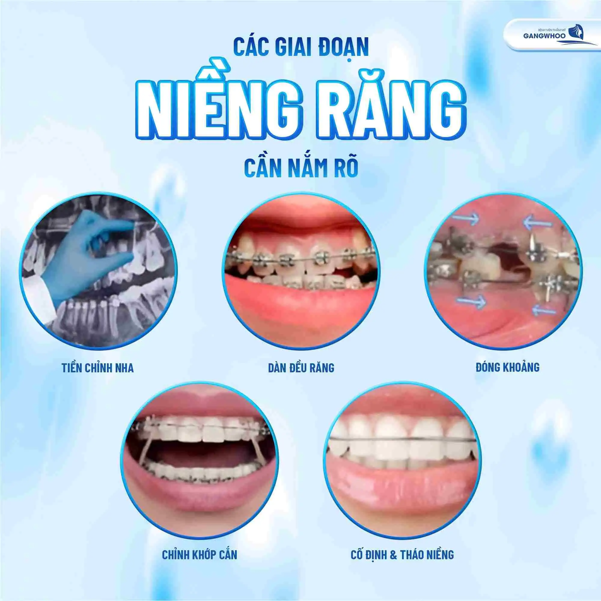 Các giai đoạn niềng răng cần nắm rõ