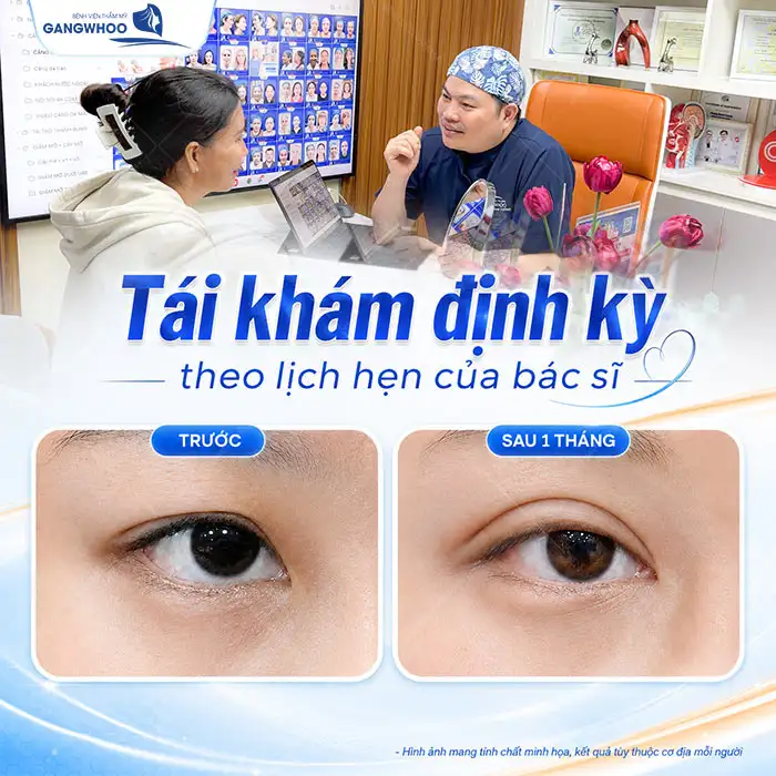 Quy trình bấm mí mắt chuẩn y khoa bao gồm mấy bước?
