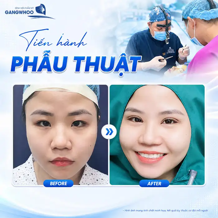 Quy trình bấm mí mắt chuẩn y khoa bao gồm mấy bước?