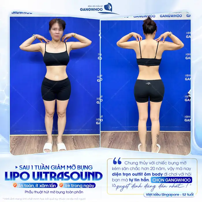 Hút Mỡ Bụng Công Nghệ Lipo Ultrasound – Giảm Mỡ An Toàn, Tạo Vóc Dáng Chuẩn Y Khoa