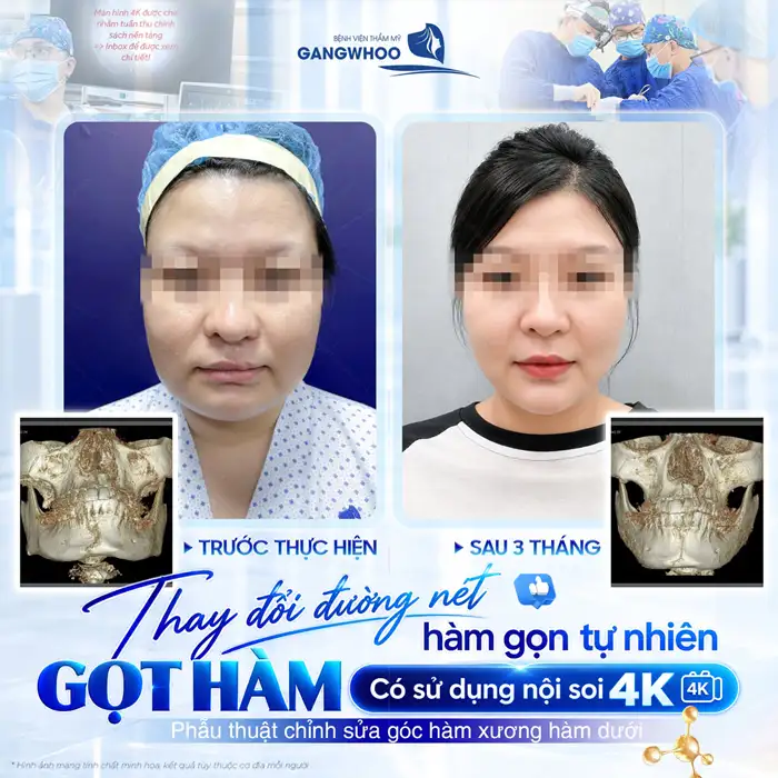 Phẫu Thuật Gọt Hàm V-Line Là Gì? Quy Trình Và Bảng Giá