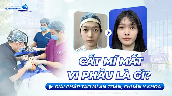 Cắt Mí Mắt Vi Phẫu Là Gì? Giải Pháp Tạo Mí An Toàn, Chuẩn Y Khoa