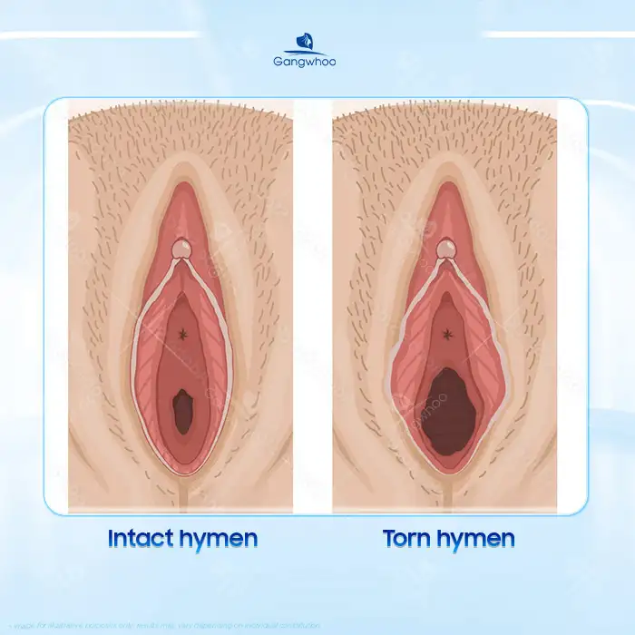Guide to distinguishing a reconstructed hymen from a natural hymen
