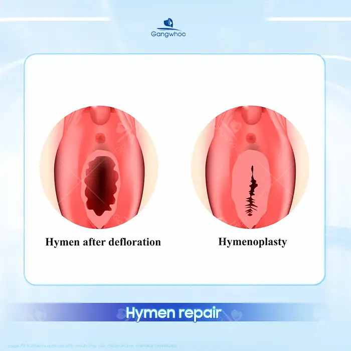 Guide to distinguishing a reconstructed hymen from a natural hymen