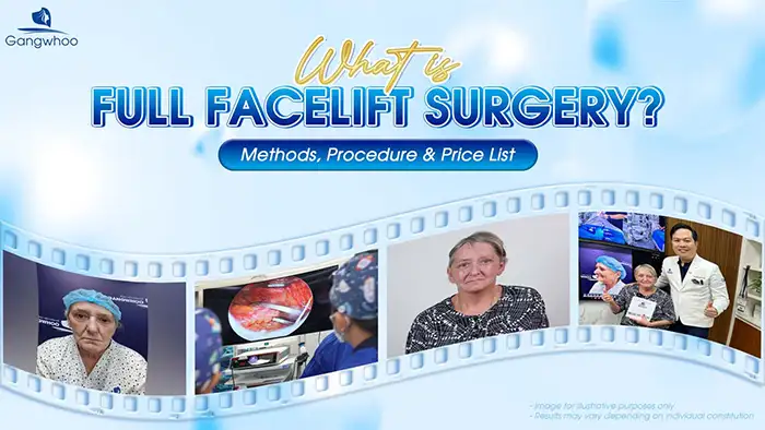 What Is Full Facelift? Methods, Procedures & Price List