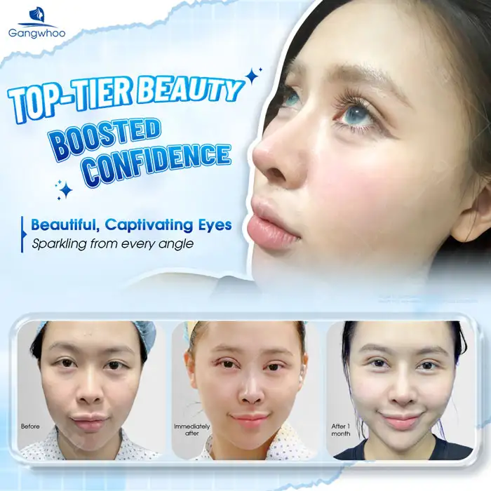 What is Indian eyelid surgery? Who is suitable for Indian eyelid surgery