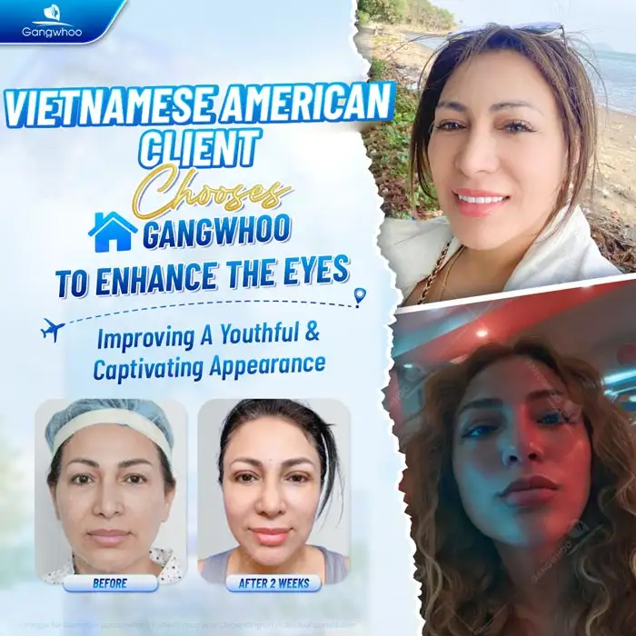 What is Indian eyelid surgery? Who is suitable for Indian eyelid surgery