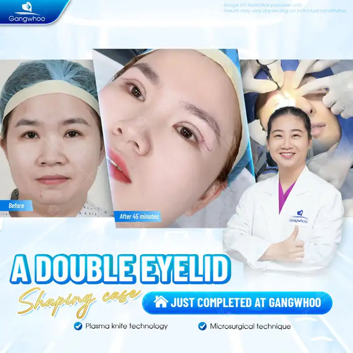 What is Indian eyelid surgery? Who is suitable for Indian eyelid surgery