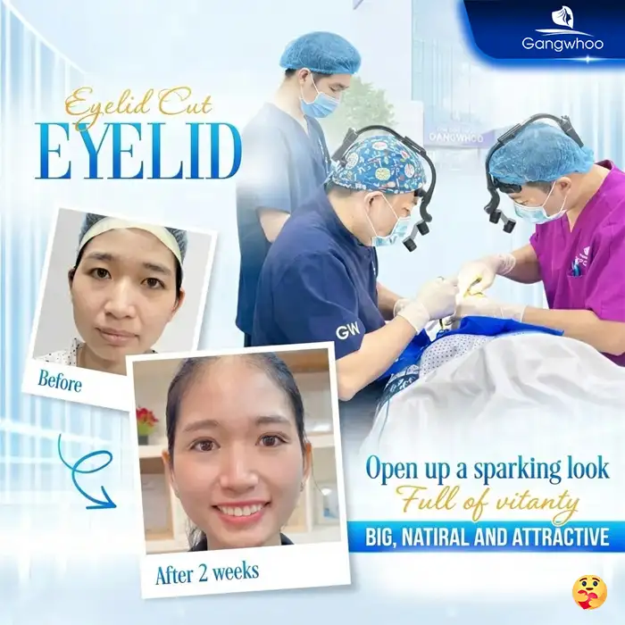 What Is Microsurgical Eyelid Surgery? A Safe, Medically Standard Solution for Double Eyelids