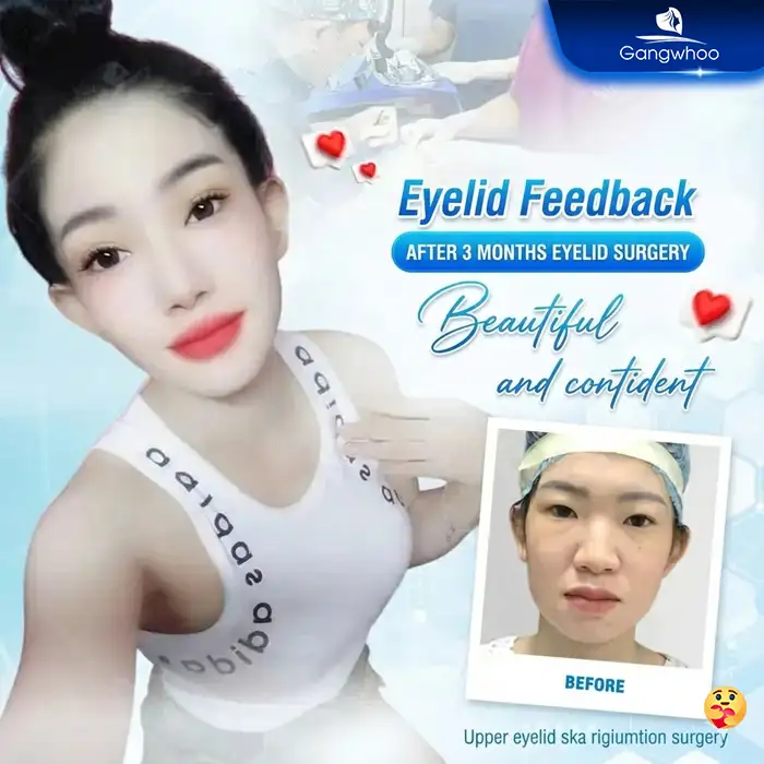 What Is Microsurgical Eyelid Surgery? A Safe, Medically Standard Solution for Double Eyelids