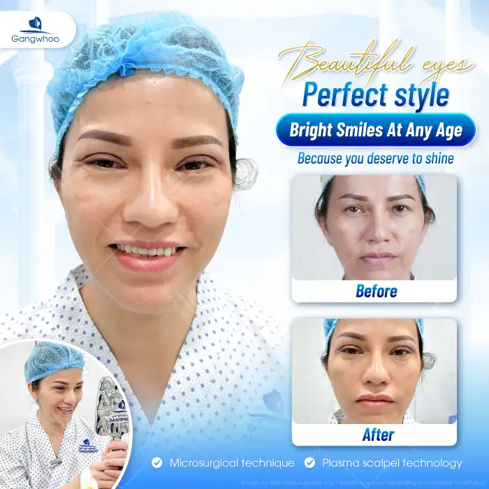 What Is Mini Deep Eyelid Surgery? Should You Choose the Mini Deep Eyelid Technique?