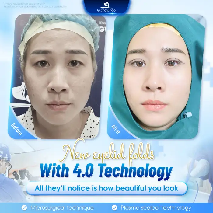 What Is Mini Deep Eyelid Surgery? Should You Choose the Mini Deep Eyelid Technique?