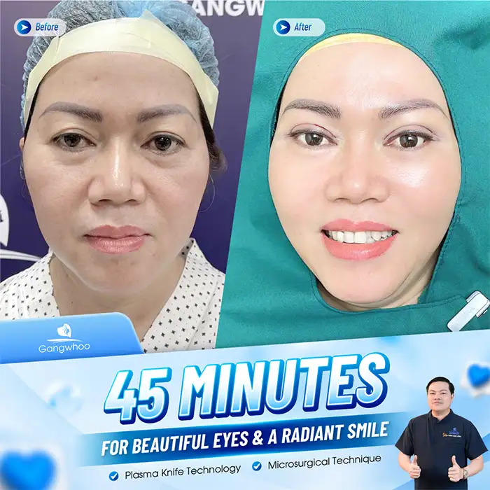 What Is Mini Deep Eyelid Surgery? Should You Choose the Mini Deep Eyelid Technique?