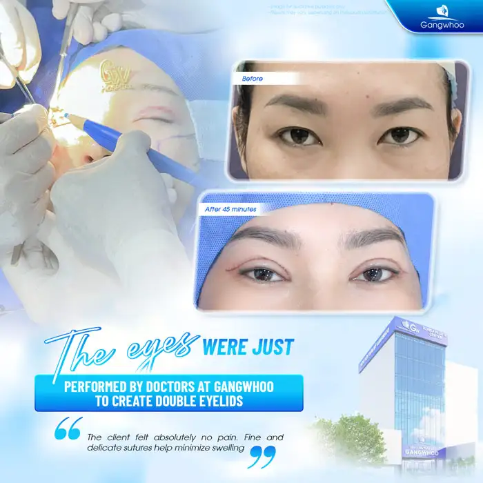 What Is the Eyelid Surgery Combined with Eye Corner Opening? What Effects Does It Have?
