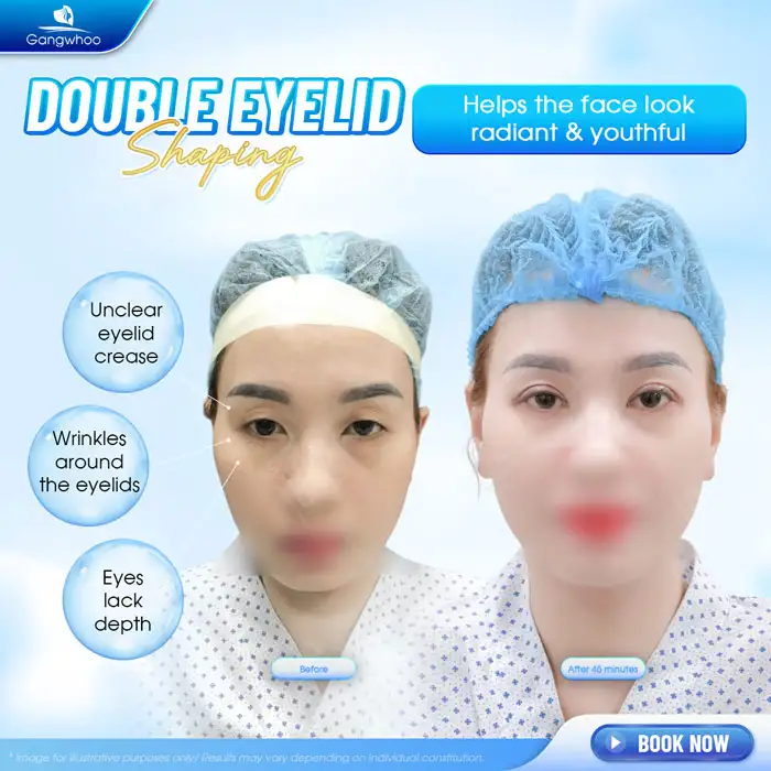 What Is the Eyelid Surgery Combined with Eye Corner Opening? What Effects Does It Have?