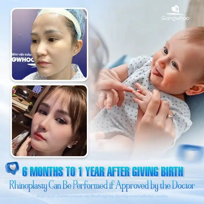 Can you undergo rhinoplasty while pregnant? Does it affect the fetus?