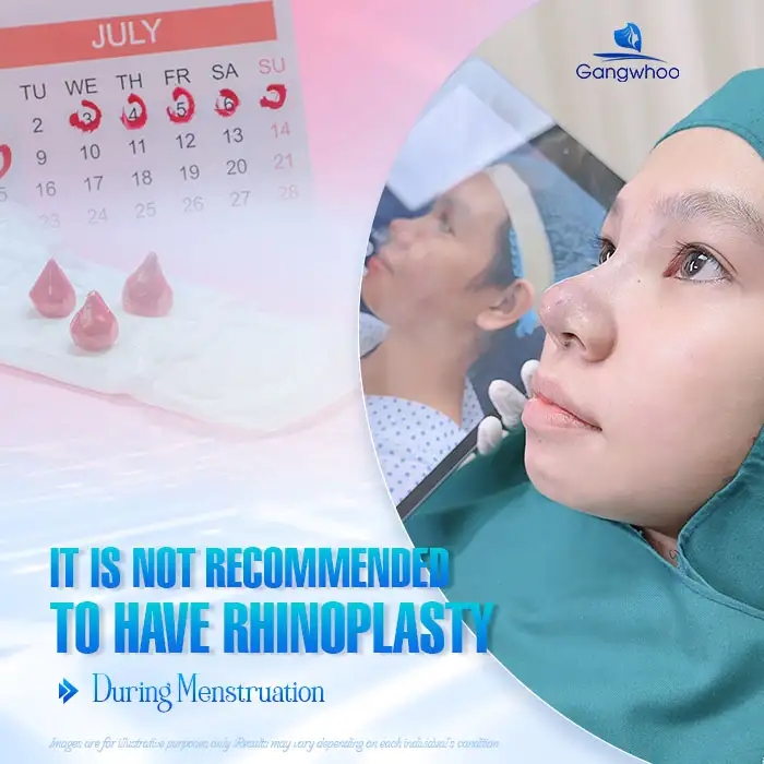 Can you undergo rhinoplasty during menstruation? Should it be avoided?