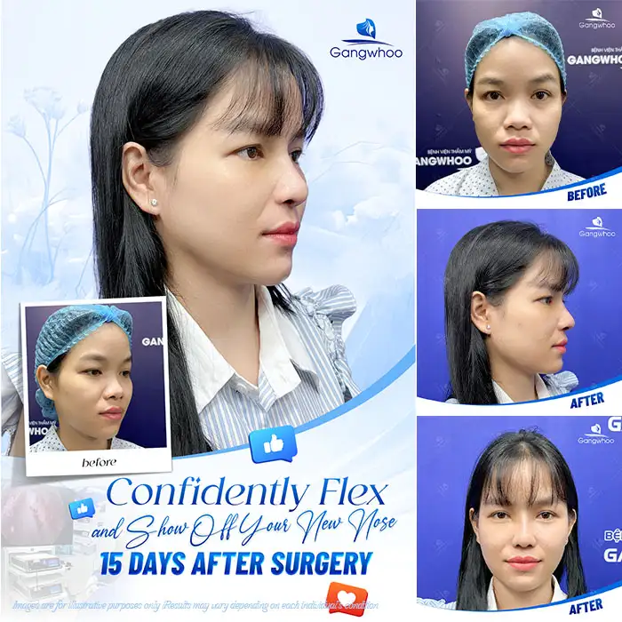 Can you undergo rhinoplasty during menstruation? Should it be avoided?