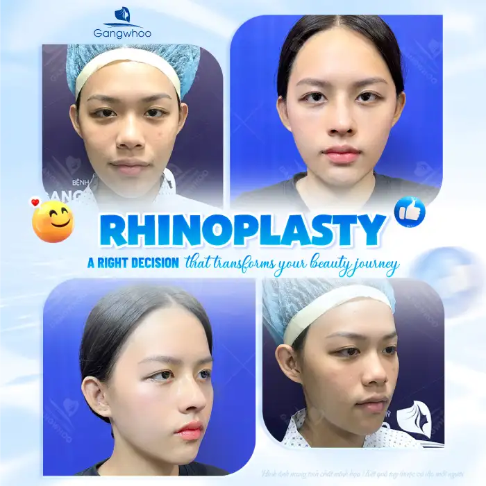 Is It Advisable to Undergo Rhinoplasty After Breast Augmentation? What Should Be Noted?