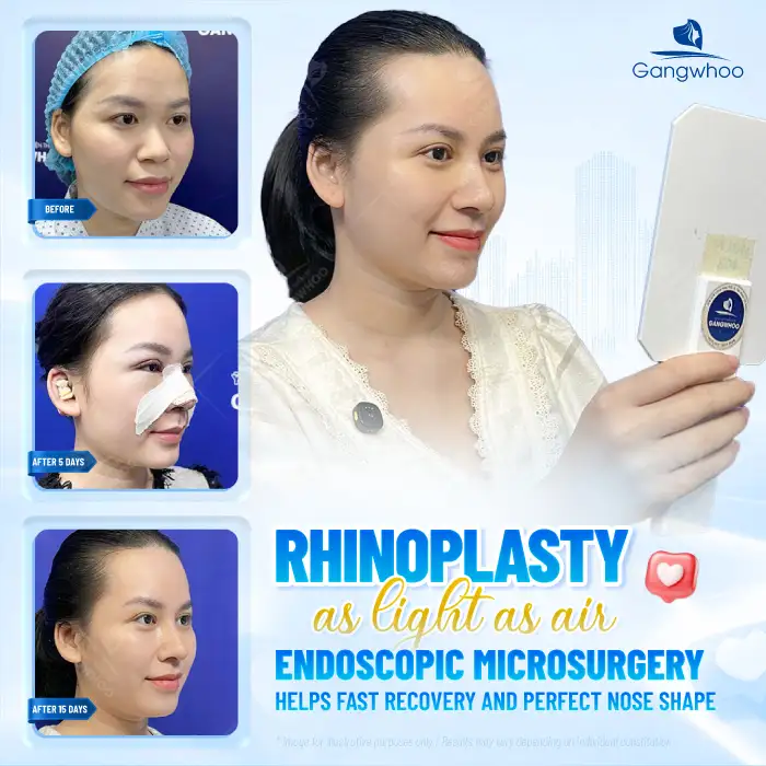 Is It Advisable to Undergo Rhinoplasty After Breast Augmentation? What Should Be Noted?