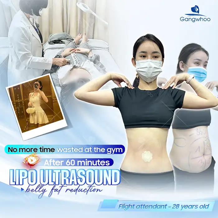 What are the most advanced fat removal technologies today? Which technology should be chosen?