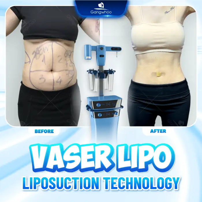 What are the most advanced fat removal technologies today? Which technology should be chosen?