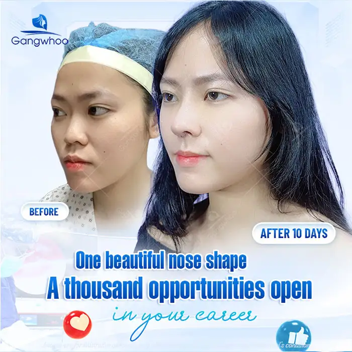 Can a Thin Nasal Skin Undergo Rhinoplasty, and What Should Be Considered?