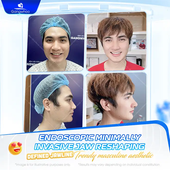 Is jaw shaving dangerous? Should jaw shaving be performed?