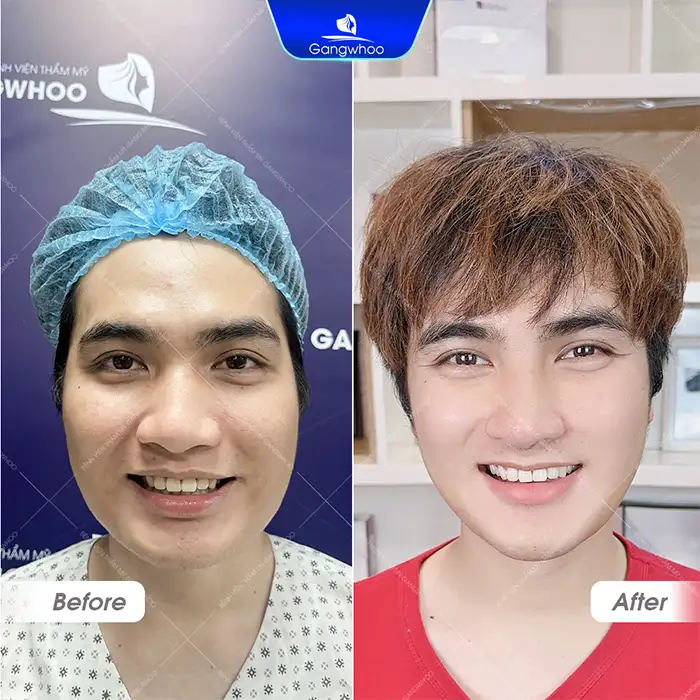 What is square jaw reduction? Notes when performing square jaw reduction