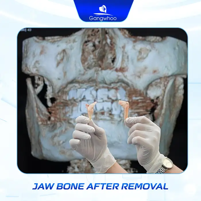 What is square jaw reduction? Notes when performing square jaw reduction