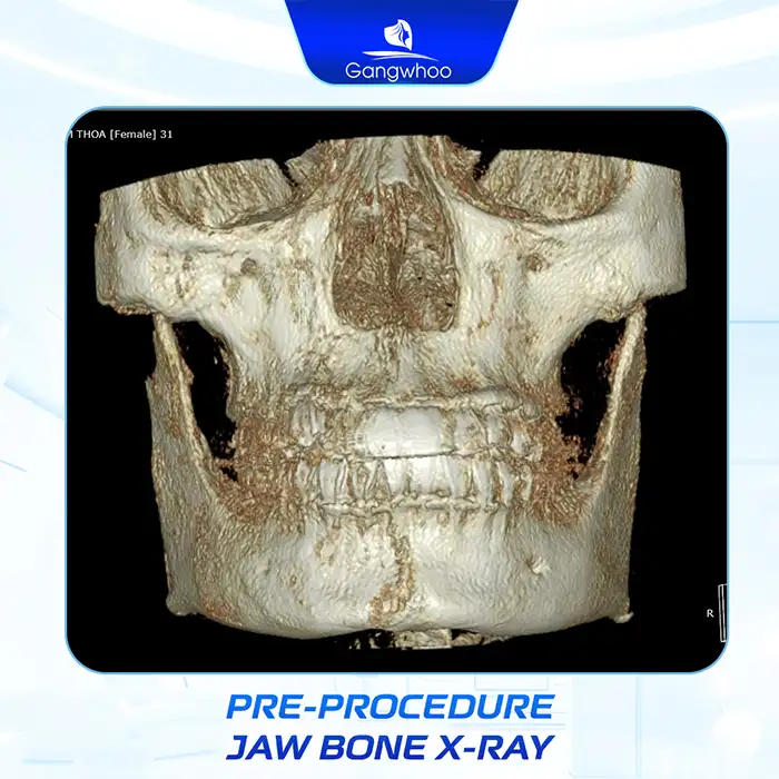What is square jaw reduction? Notes when performing square jaw reduction