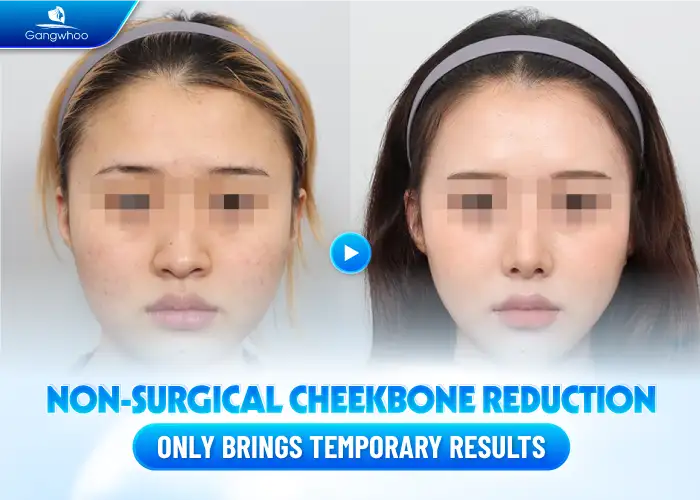 Are there any non-surgical methods to lower the cheekbones? Do the results last long?