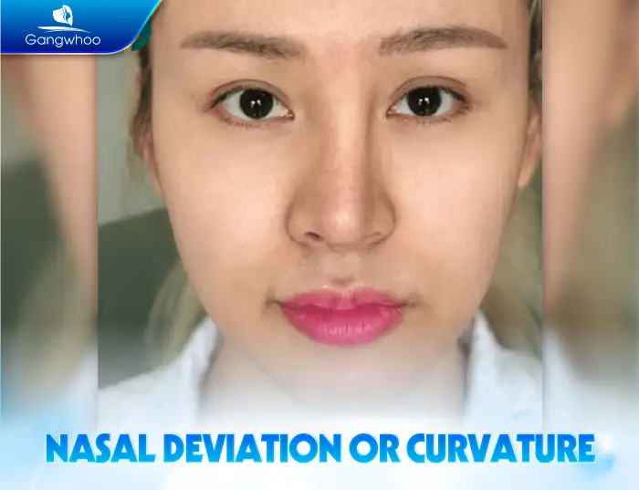 What are the possible consequences of S-Line rhinoplasty? What should be noted?