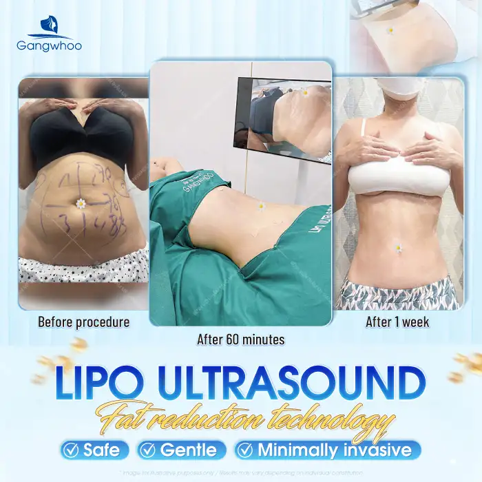 Does abdominal liposuction hurt? Which technology allows painless abdominal liposuction?