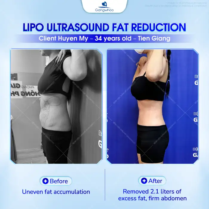 Does abdominal liposuction hurt? Which technology allows painless abdominal liposuction?