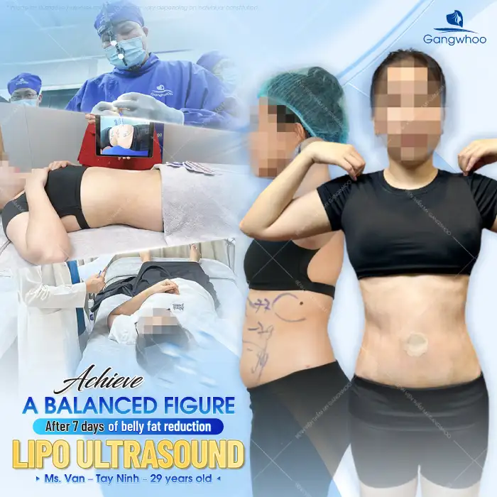 Does abdominal liposuction hurt? Which technology allows painless abdominal liposuction?