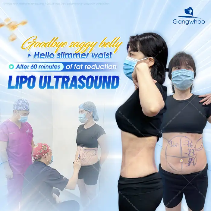 Does abdominal liposuction hurt? Which technology allows painless abdominal liposuction?