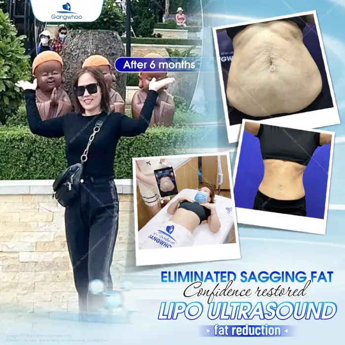 Is abdominal liposuction dangerous? Important things to know before undergoing the procedure