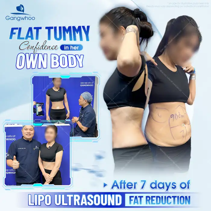 Is abdominal liposuction dangerous? Important things to know before undergoing the procedure