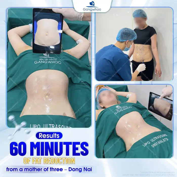 Is abdominal liposuction dangerous? Important things to know before undergoing the procedure