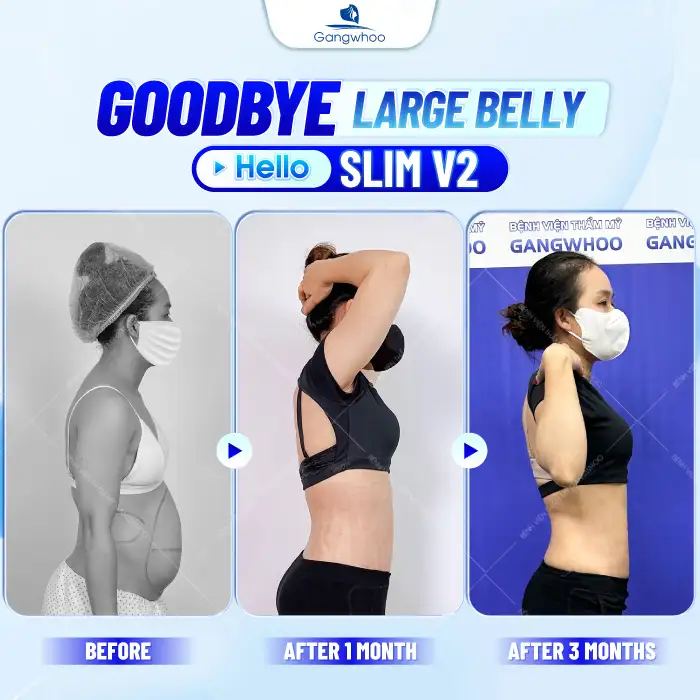 Is abdominal liposuction dangerous? Important things to know before undergoing the procedure