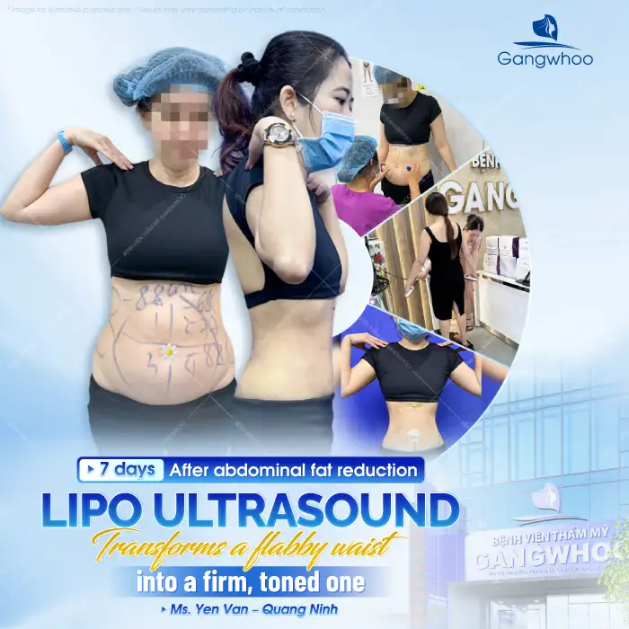 How long do the results of abdominal liposuction last? How to maintain long-term effectiveness