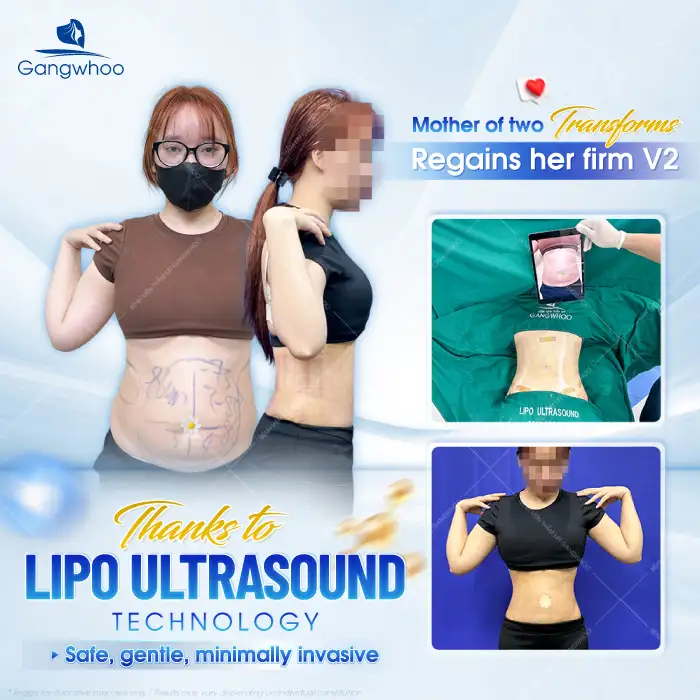 How long do the results of abdominal liposuction last? How to maintain long-term effectiveness