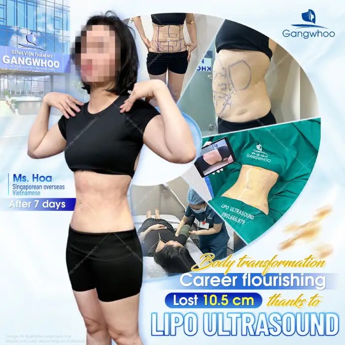 How long do the results of abdominal liposuction last? How to maintain long-term effectiveness