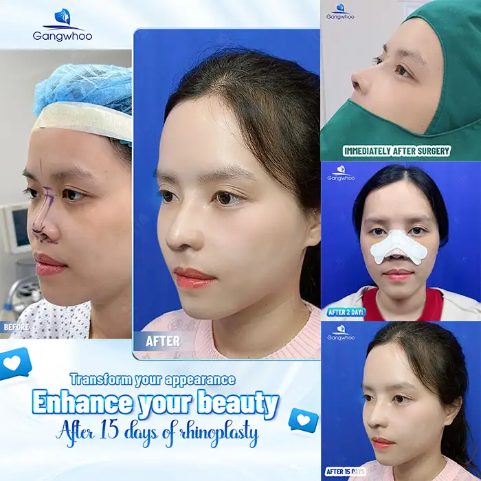 Khuôn mặt hơi dài thì nâng mũi dáng nào đẹp? Tư vấn dáng mũi phù hợp