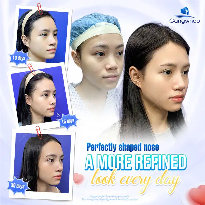 Khuôn mặt hơi dài thì nâng mũi dáng nào đẹp? Tư vấn dáng mũi phù hợp