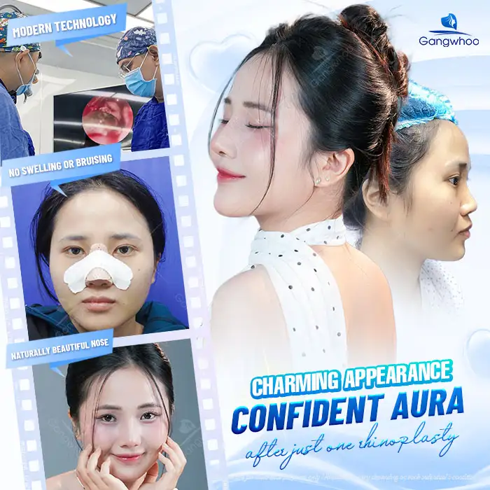 Which rhinoplasty style looks the most beautiful and natural for an oval face?