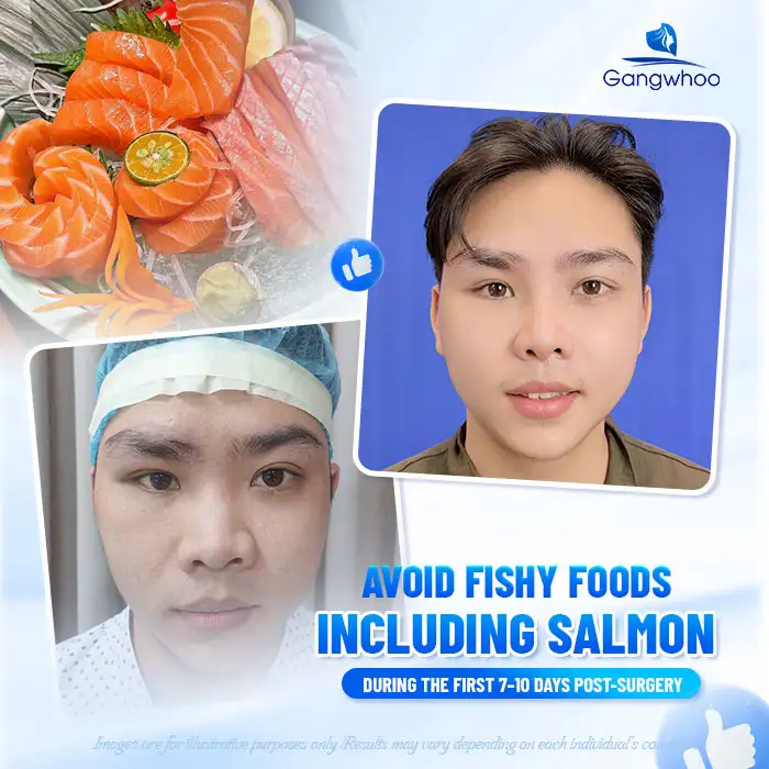 Is it okay to eat salmon after rhinoplasty? When should salmon be eaten?