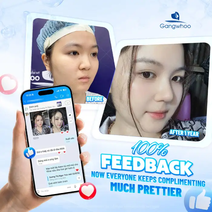 What Is Ultra V Lift Thread Nose Lift? Advantages and Disadvantages of the Method